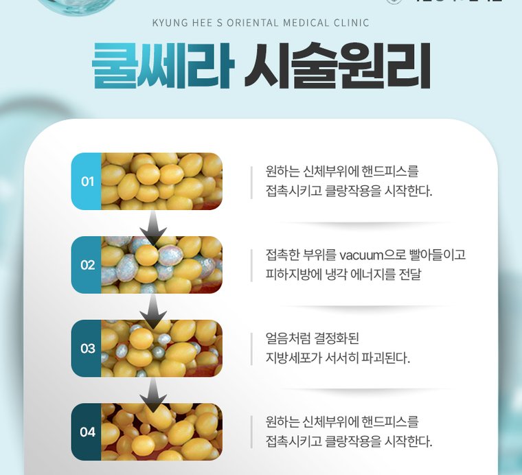쿨쎄라 시술 원리 4단계